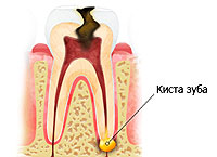 Лечение кисты зуба 